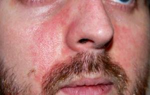 аллергия на лице