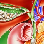 Холецистит