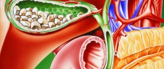 Холецистит